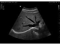 Samsung Medison V8 Samsung Medison V8