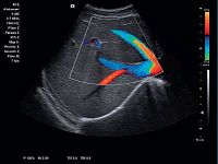 УЗИ аппарат Siemens ACUSON x700