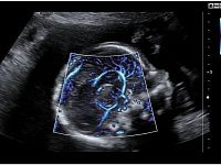 Samsung Medison HS60