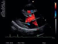 УЗИ аппарат Siemens ACUSON x700