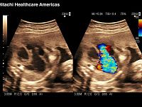 УЗИ аппарат Hitachi Aloka ProSound F37