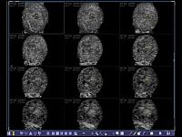 УЗИ аппарат Siemens ACUSON S2000