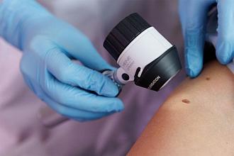 Российская система сможет диагностировать меланому за 30 минут