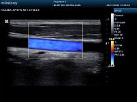 УЗИ аппарат Mindray DP-50 Color