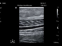 УЗИ аппарат Philips ClearVue 850