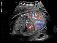 УЗИ аппарат General Electric Voluson E8