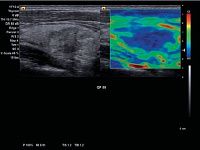 УЗИ аппарат Siemens ACUSON x700