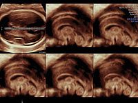 УЗИ аппарат General Electric Voluson E8