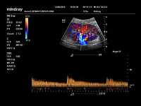 УЗИ аппарат Mindray M6 EXP