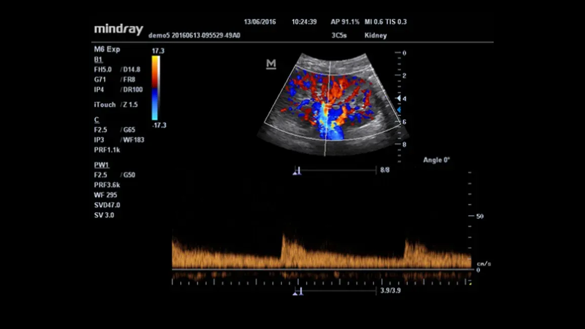УЗИ аппарат Mindray M6 EXP